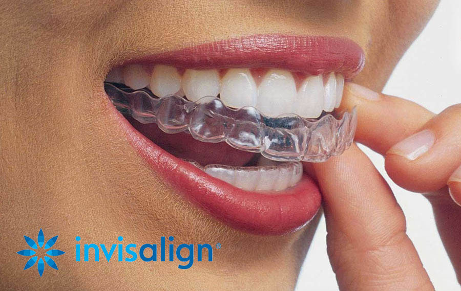 invisalign-beugel-onzichtbaar-orthodontist